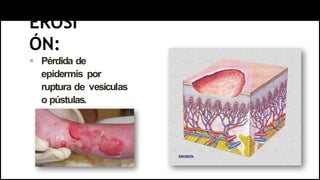 EROSI
ÓN:
 Pérdida de
epidermis por
ruptura de vesículas
o pústulas.
 