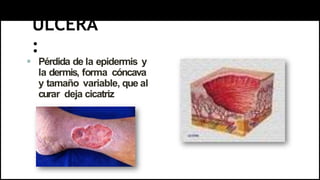 ÚLCERA
:
 Pérdida de la epidermis y
la dermis, forma cóncava
y tamaño variable, que al
curar deja cicatriz
 