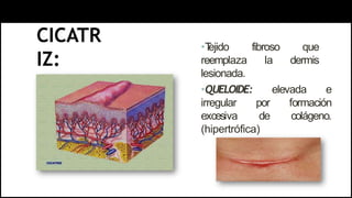 CICATR
IZ:
•T
ejido fibroso que
reemplaza la dermis
lesionada.
•QUELOIDE: elevada e
irregular por formación
excesiva de colágeno.
(hipertrófica)
 