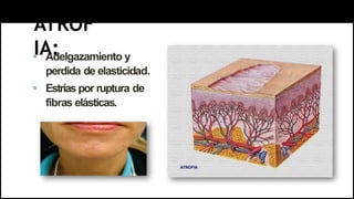 ATROF
IA:
 Adelgazamiento y
perdida de elasticidad.
 Estrías por ruptura de
fibras elásticas.
 