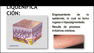 LIQUENIFICA
CIÓN: • Engrosamiento de la
epidermis, la cual se torna
rugosa e hiperpigmentada.
• Resulta de procesos
irritativos crónicos.
 