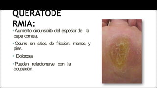 QUERATODE
RMIA:
Aumento circunscrito del espesor de la
capa cornea.
Ocurre en sitios de fricción: manos y
pies
 Dolorosa
Pueden relacionarse con la
ocupación
 