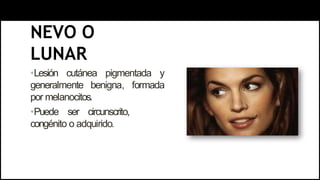 NEVO O
LUNAR
•Lesión cutánea pigmentada y
generalmente benigna, formada
por melanocitos.
•Puede ser circunscrito,
congénito o adquirido.
 