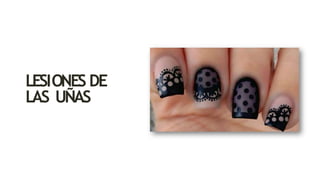 LESIONES DE
LAS UÑAS
 