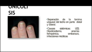 ONICOLI
SIS
Separación de la lamina
ungueal del lecho en parte distal
y lateral.
Causas sistémicas: LES
,
Hipotiroidismo, anemia
ferropénica, embarazo,
infeccionesmicóticas
 