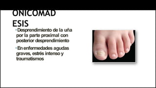 ONICOMAD
ESIS
Desprendimiento de la uña
por la parte proximal con
posterior desprendimiento
Enenfermedades agudas
graves, estrés intensoy
traumatismos
 