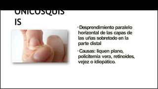 ONICOSQUIS
IS Desprendimiento paralelo
horizontal de las capas de
las uñas sobretodo en la
parte distal
Causas: liquen plano,
policitemia vera, retinoides,
vejez o idiopático.
 