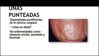 UÑAS
PUNTEADAS
Depresiones puntiformes
de la lamina ungueal
 “uñas en dedal”
Enenfermedades como
alopecia areata, psoriasis y
traumas
 