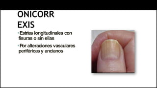 ONICORR
EXIS
Estrías longitudinales con
fisuras o sin ellas
Por alteraciones vasculares
periféricasy ancianos
 