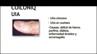 COILONIQ
UIA
 Uña cóncava
 Uña en cuchara
Causas: déficit de hierro,
porfiria, diálisis,
enfermedad tiroidea y
acromegalia.
 