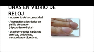 UÑAS EN VIDRIO DE
RELOJ
 Incremento de la convexidad
Acompañan a los dedosen
palillo de tambor
(hipocratismo digital)
Enenfermedadeshipóxicas
crónicas, endocrinas,
metabólicas y digestivas.
 