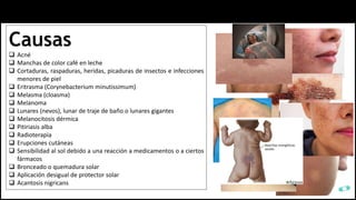 Causas
 Acné
 Manchas de color café en leche
 Cortaduras, raspaduras, heridas, picaduras de insectos e infecciones
menores de piel
 Eritrasma (Corynebacterium minutissimum)
 Melasma (cloasma)
 Melanoma
 Lunares (nevos), lunar de traje de baño o lunares gigantes
 Melanocitosis dérmica
 Pitiriasis alba
 Radioterapia
 Erupciones cutáneas
 Sensibilidad al sol debido a una reacción a medicamentos o a ciertos
fármacos
 Bronceado o quemadura solar
 Aplicación desigual de protector solar
 Acantosis nigricans
 