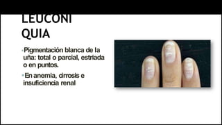LEUCONI
QUIA
Pigmentación blanca de la
uña: total o parcial, estriada
o en puntos.
Enanemia, cirrosis e
insuficiencia renal
 