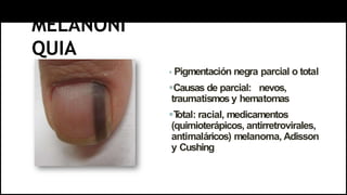MELANONI
QUIA
 Pigmentación negra parcial o total
Causas de parcial: nevos,
traumatismos y hematomas
T
otal: racial, medicamentos
(quimioterápicos, antirretrovirales,
antimaláricos) melanoma, Adisson
y Cushing
 