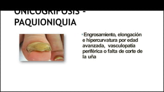 ONICOGRIFOSIS -
PAQUIONIQUIA
Engrosamiento, elongación
e hipercurvatura por edad
avanzada, vasculopatía
periférica o falta de corte de
la uña
 