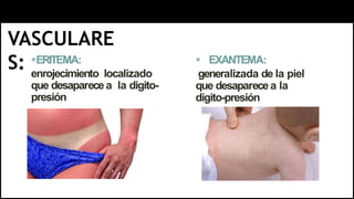 1-
VASCULARE
S: ERITEMA:
enrojecimiento localizado
que desaparece a la digito-
presión
 EXANTEMA:
generalizada de la piel
que desaparece a la
digito-presión
 