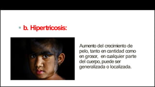  b. Hipertricosis:
Aumento del crecimiento de
pelo, tanto en cantidad como
en grosor, en cualquier parte
del cuerpo,puede ser
generalizada o localizada.
 