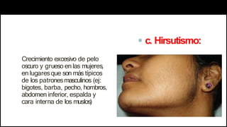  c. Hirsutismo:
Crecimiento excesivo de pelo
oscuro y grueso en las mujeres,
en lugaresque son más típicos
de los patronesmasculinos (ej:
bigotes, barba, pecho, hombros,
abdomen inferior, espalda y
cara interna de los muslos)
 