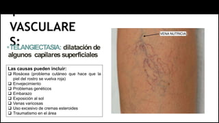 1-
VASCULARE
S:
TELANGIECTASIA: dilatación de
algunos capilares superficiales
Las causas pueden incluir:
 Rosácea (problema cutáneo que hace que la
piel del rostro se vuelva roja)
 Envejecimiento
 Problemas genéticos
 Embarazo
 Exposición al sol
 Venas varicosas
 Uso excesivo de cremas esteroides
 Traumatismo en el área
 