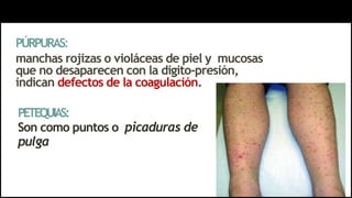 PÚRPURAS:
manchas rojizas o violáceas de piel y mucosas
que no desaparecen con la digito-presión,
indican defectos de la coagulación.
PETEQUIAS:
Son como puntos o picaduras de
pulga
 