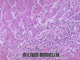 INFILTRADO MONONUCLEAR
 