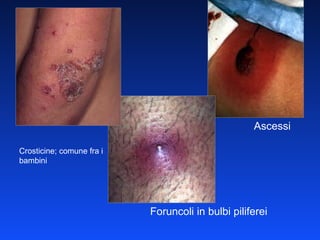 Ascessi Foruncoli in bulbi piliferei Crosticine; comune fra i bambini 