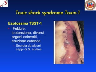Toxic shock syndrome Toxin-1 Esotossina TSST-1 Febbre, ipotensione, diversi organi coinvolti, eruzione cutanea Secreta da alcuni ceppi di  S. aureus   