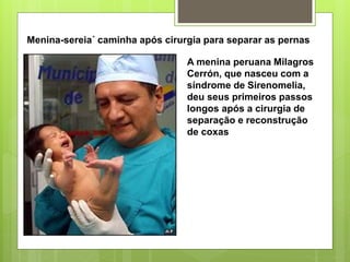 Menina-sereia´ caminha após cirurgia para separar as pernas
A menina peruana Milagros
Cerrón, que nasceu com a
síndrome de Sirenomelia,
deu seus primeiros passos
longos após a cirurgia de
separação e reconstrução
de coxas
 