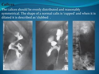 Presentation on urological dialysis and j | PDF