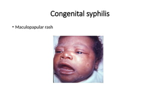 TORCH infections- obstetrics and gynecology | PPTX