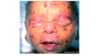 Torch Infection Rashes TORCH infections- obstetrics and gynecology | PPTX