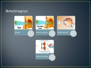 Miopia   Hipermetropía    Astigmatismo




         Anisometropías
 