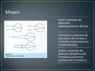 Axial: aumento de
diámetro
anteroposterior del ojo

Curvatura: aumento de
curvatura de córnea o
cristalino (queratocono
o esferofaquia)
Indice: aumento de
potencia dioptrica del
cristalino (esclrosis
nuclear del cristalino)
 
