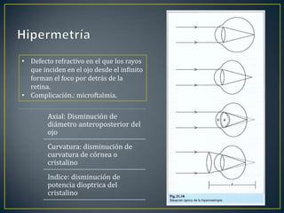 • Defecto refractivo en el que los rayos
  que inciden en el ojo desde el infinito
  forman el foco por detrás de la
  retina.
• Complicación.: microftalmia.

        Axial: Disminución de
        diámetro anteroposterior del
        ojo
        Curvatura: disminución de
        curvatura de córnea o
        cristalino
        Indice: disminución de
        potencia dioptrica del
        cristalino
 