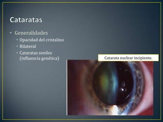 • Generalidades
  • Opacidad del cristalino
  • Bilateral
  • Cataratas seniles
    (influencia genética)     Catarata nuclear incipiente.
 