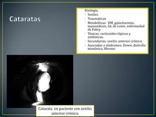 Etiología.
                           • Seniles
                           • Traumáticas
                           • Metabólicas: DM, galactosemia,
                             manosidosis, Sd. de Lowe, enfermedad
                             de Fabry.
                           • Tóxicas: corticoides tópicos y
                             sistémicas.
                           • Secundarias: uveítis anterior crónica.
                           • Asociadas a síndromes: Down, distrofia
                             miotónica, Werner.




Catarata en paciente con uveítis
       anterior crónica.
 