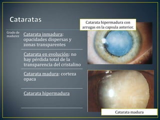 Catarata hipermadura con
                                          arrugas en la capsula anterior.
Grado de
madurez    Catarata inmadura:
           opacidades dispersas y
           zonas transparentes
           Catarata en evolución: no
           hay pérdida total de la
           transparencia del cristalino
           Catarata madura: corteza
           opaca

           Catarata hipermadura


                                                             Catarata madura
 