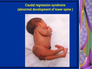 Caudal regression syndrome
(abnormal development of lower spine )
 