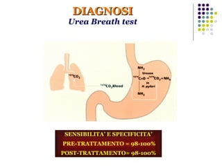 DIAGNOSI Urea Breath test SENSIBILITA’ E SPECIFICITA’ PRE-TRATTAMENTO = 98-100% POST-TRATTAMENTO= 98-100% 