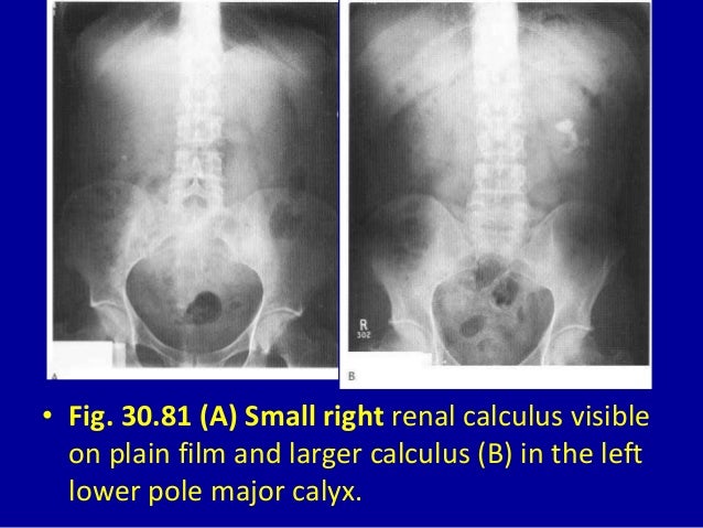 30 DAVID SUTTON PICTURES THE KIDNEY AND URETERS