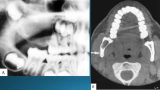 Giant Cell Lesions | PPTX
