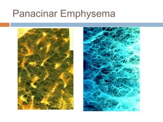 Panacinar Emphysema
 