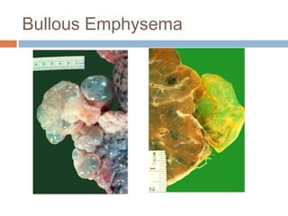 Bullous Emphysema
 