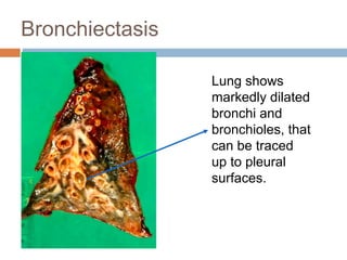 Bronchiectasis
Lung shows
markedly dilated
bronchi and
bronchioles, that
can be traced
up to pleural
surfaces.
 
