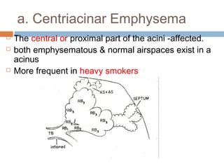 a. Centriacinar Emphysema
 The central or proximal part of the acini -affected.
 both emphysematous & normal airspaces exist in a
acinus
 More frequent in heavy smokers
 
