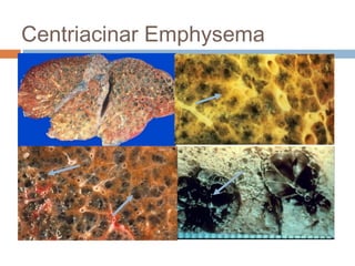 Centriacinar Emphysema
 