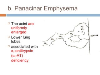 b. Panacinar Emphysema
 The acini are
uniformly
enlarged
 Lower lung
lobes
 associated with
α1-antitrypsin
(α1-AT)
deficiency
 
