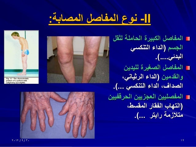 الأمراض الروماتزمية