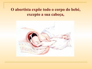 O abortista expõe todo o corpo do bebé, excepto a sua cabeça, 