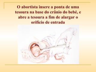 O abortista insere a ponta de uma tesoura na base do crânio do bebé, e abre a tesoura a fim de alargar o orifício de entrada 